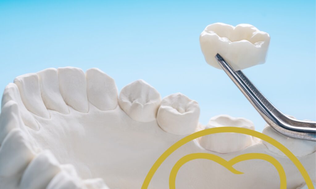 Zirconia and gold crowns.