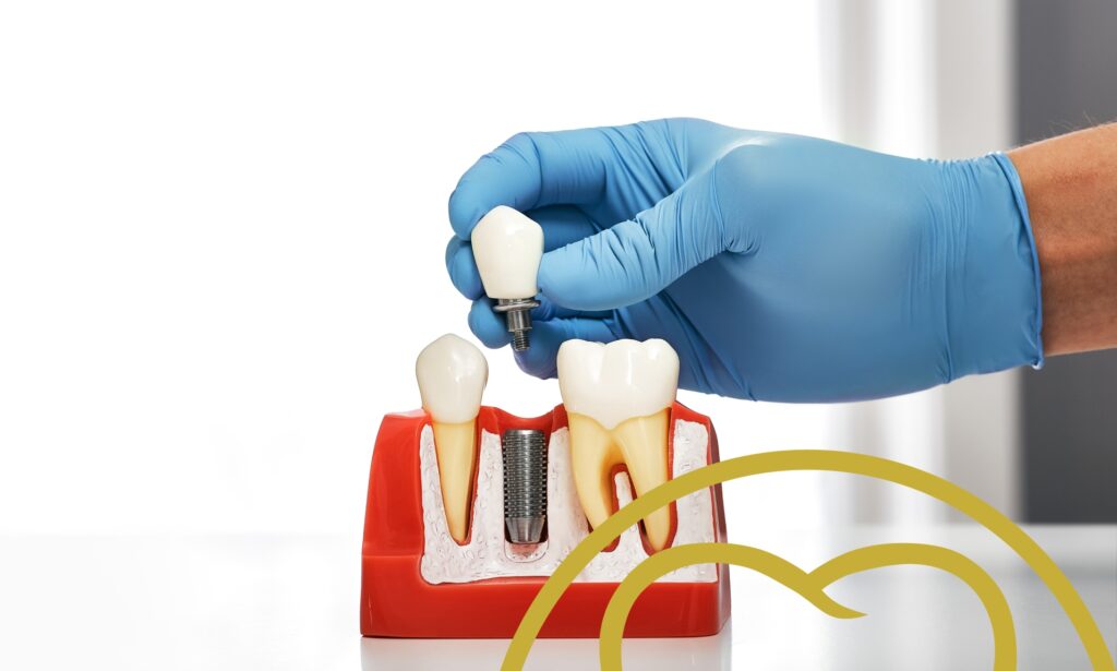Dental implants are best for missing teeth.