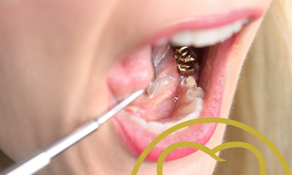 Gold dental crowns are still a good choice.